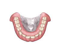 金属床義歯（チタン）