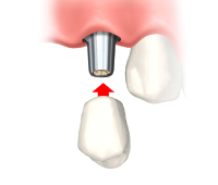 インプラント上部構造
