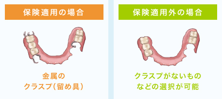 保険適用の場合　金属のクラスプ（留め具）、保険適用外の場合　クラスプがないものなどの選択が可能