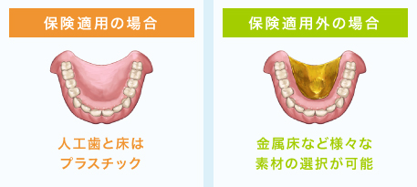 保険適用の場合　人工歯と床はプラスチック、保険適用外の場合　金属床など様々な素材の選択が可能