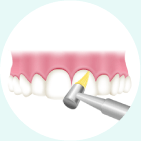 歯間や歯面をクリーニング